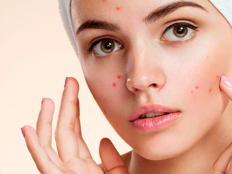 acne mitos e verdades