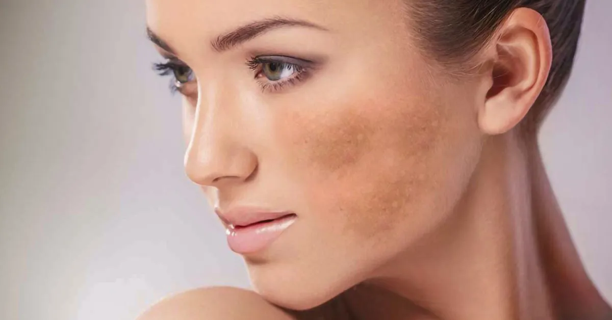 melasma